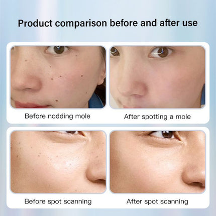 Dotting Mole Pen Nevus Removal Tool Spot Remover Red Blue Light Therapy Beauty