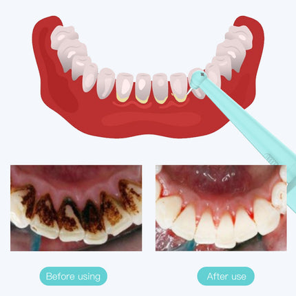 Intelligent High-Frequency Vibration Dental Calculus & Stain Remover(blue)
